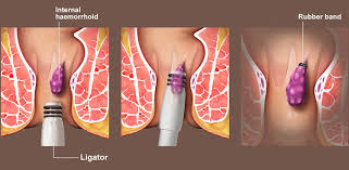 hemorrhoids