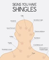 shingles