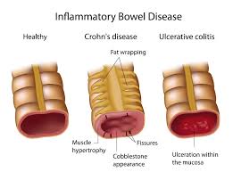 Navigating Life with Crohn’s Disease: Understanding the Challenges and Triumphs