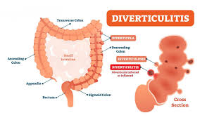 Navigating the Challenges of Diverticulitis: Understanding Causes, Symptoms, and Treatment