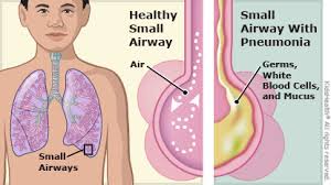 pneumonia