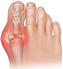 Understanding Gout: Causes, Symptoms, and Treatment in Australia