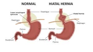 hernia