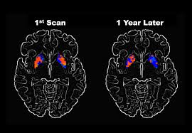 parkinson's disease