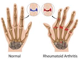 rheumatoid arthritis