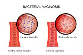 bacterial vaginosis