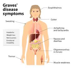 Navigating Graves’ Disease: Understanding Symptoms, Causes, and Treatment in Australia