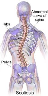 scoliosis