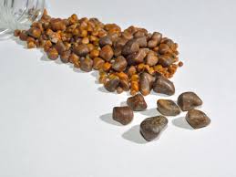 gallstones