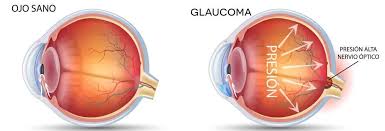 glaucoma