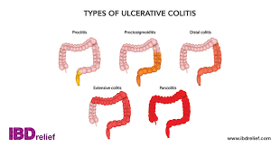 ulcerative colitis