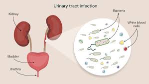 utis