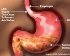 Navigating Acid Reflux: Insights into Managing Heartburn and Discomfort