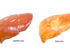 fatty liver
