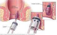Effective Hemorrhoid Treatment Options for Relief