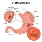 Navigating the Terrain of Stomach Ulcers: Causes, Symptoms, and Treatment Insights