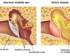 ear infection