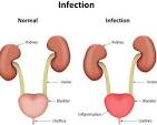 urinary tract infection