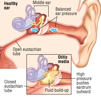 middle ear infection