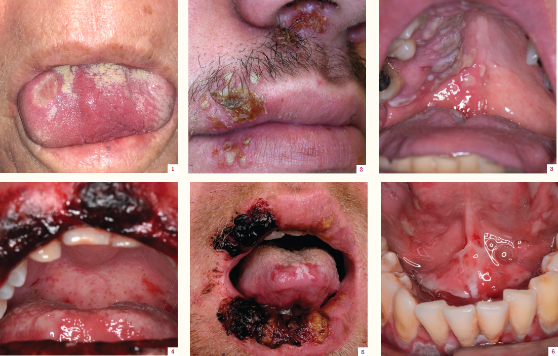 ulcers in mouth