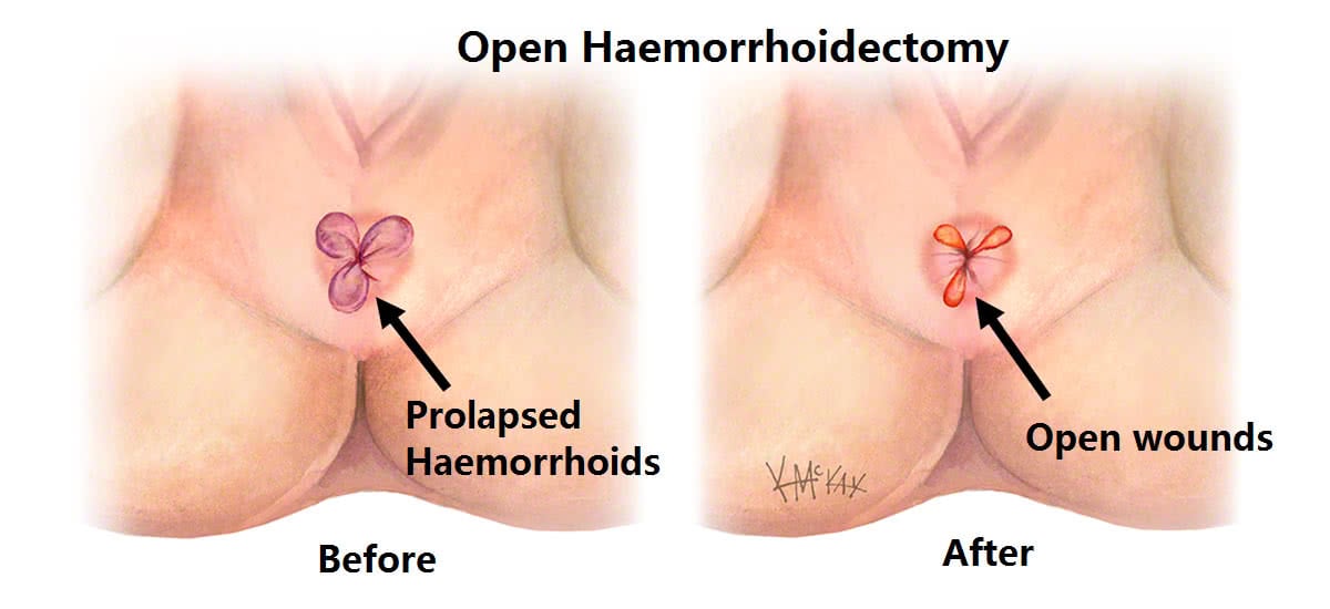 external hemorrhoids