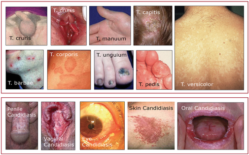 Unveiling the Impact of Fungal Infections on Health and Wellness