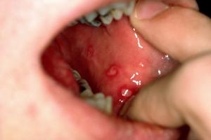 Dealing with Pain: Understanding and Managing Ulcers in the Mouth