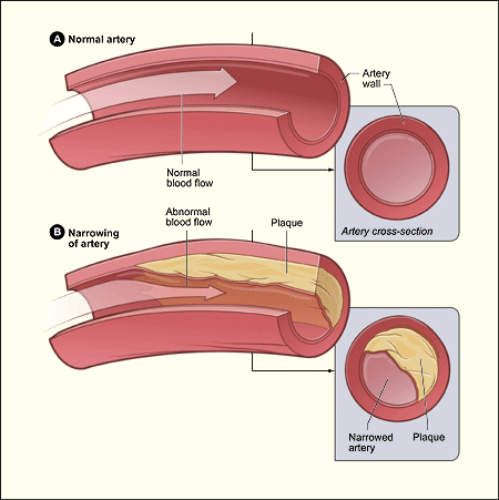 Decoding LDL Cholesterol: Navigating the Path to Heart Health