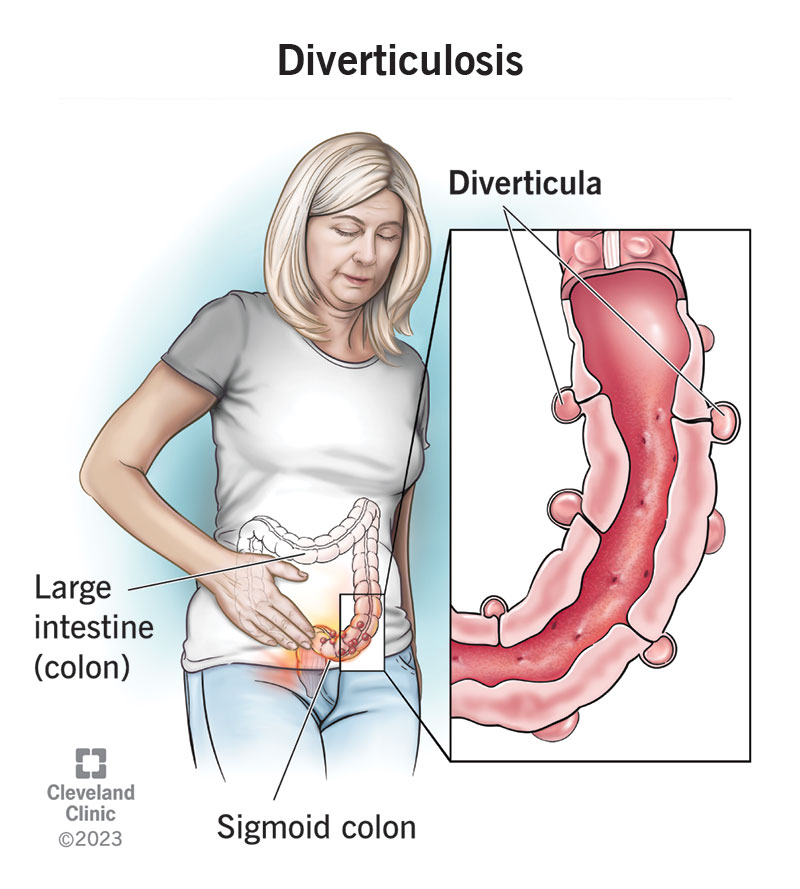 diverticulitis treatment