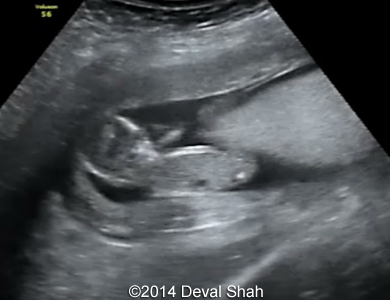 molar pregnancy