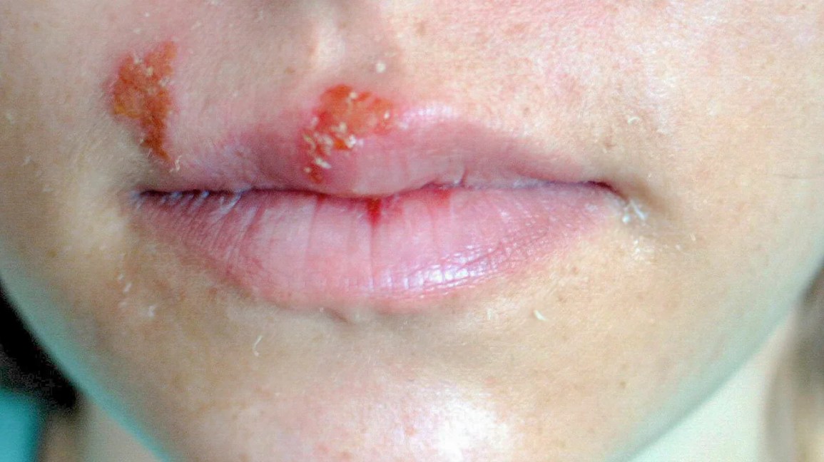 cold sore on lip